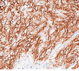 ANO1 / DOG1 / TMEM16A Antibody - Membranous staining of DOG1 in GIST