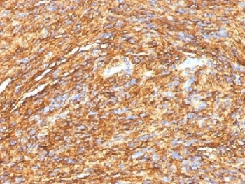 ANO1 / DOG1 / TMEM16A Antibody - IHC testing of FFPE human gastrointestinal stromal tumor (GIST) with DOG 1 antibody (DG1/1484). Required HIER: boil tissue sections in 10mM citrate buffer, pH 6, for 10-20 min.