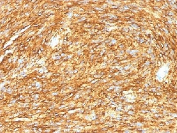 ANO1 / DOG1 / TMEM16A Antibody - IHC testing of FFPE human gastrointestinal stromal tumor (GIST) with DOG1 antibody (DG1/1485). Required HIER: boil tissue sections in 10mM citrate buffer, pH 6, for 10-20 min.