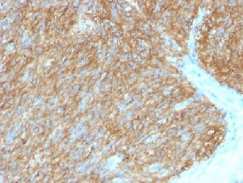 ANO1 / DOG1 / TMEM16A Antibody - IHC testing of FFPE human gastrointestinal stromal tumor (GIST) with DOG1 antibody (DG1/1486). Required HIER: boil tissue sections in 10mM citrate buffer, pH 6, for 10-20 min.