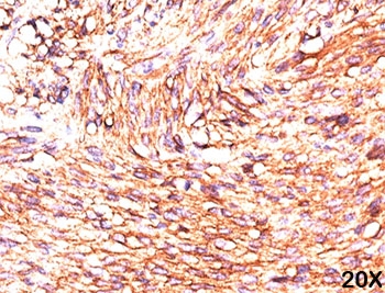 ANO1 / DOG1 / TMEM16A Antibody - TMEM16A DOG1 antibody DG1/447 immunohistochemistry gastrointestinal stromal tumor 20X.  This image was taken for the unmodified form of this product. Other forms have not been tested.