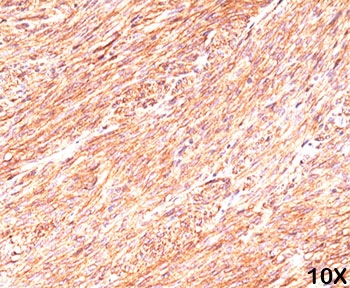 ANO1 / DOG1 / TMEM16A Antibody - TMEM16A DOG1 antibody DG1/447 immunohistochemistry gastrointestinal stromal tumor 10X.  This image was taken for the unmodified form of this product. Other forms have not been tested.