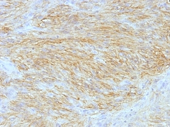 ANO1 / DOG1 / TMEM16A Antibody - Formalin-fixed, paraffin-embedded human GIST stained with ANO1 antibody (SPM580).  This image was taken for the unmodified form of this product. Other forms have not been tested.