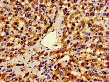 ANO1 / DOG1 / TMEM16A Antibody - Immunohistochemistry image of paraffin-embedded human liver cancer at a dilution of 1:100