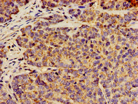 ANO1 / DOG1 / TMEM16A Antibody - Immunohistochemistry image of paraffin-embedded human ovarian cancer at a dilution of 1:100