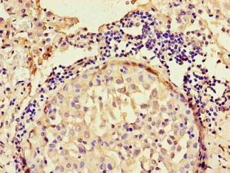 ANO4 Antibody - Immunohistochemistry of paraffin-embedded human lung cancer using ANO4 Antibody at dilution of 1:100