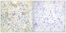 ANO7 / TMEM16G / NGEP Antibody - Immunohistochemistry analysis of paraffin-embedded human prostate carcinoma tissue, using TM16G Antibody. The picture on the right is blocked with the synthesized peptide.