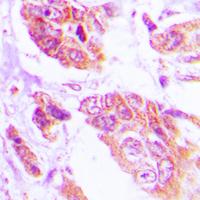 ANO7 / TMEM16G / NGEP Antibody - Immunohistochemical analysis of NGEP staining in human lung cancer formalin fixed paraffin embedded tissue section. The section was pre-treated using heat mediated antigen retrieval with sodium citrate buffer (pH 6.0). The section was then incubated with the antibody at room temperature and detected using an HRP conjugated compact polymer system. DAB was used as the chromogen. The section was then counterstained with hematoxylin and mounted with DPX.