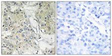 ANO9 / TMEM16J Antibody - Immunohistochemistry analysis of paraffin-embedded human breast carcinoma tissue, using TM16J Antibody. The picture on the right is blocked with the synthesized peptide.