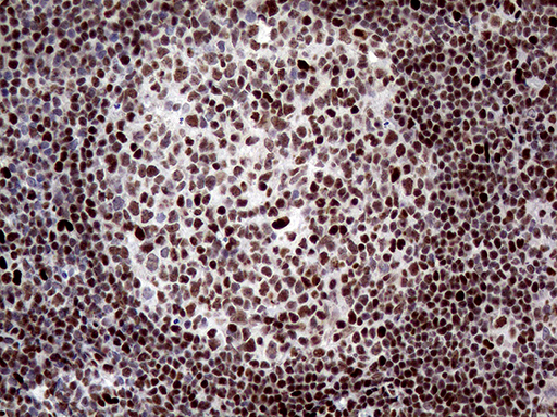 ANP32C Antibody - Immunohistochemical staining of paraffin-embedded Human lymph node tissue within the normal limits using anti-ANP32C mouse monoclonal antibody. (Heat-induced epitope retrieval by 1mM EDTA in 10mM Tris buffer. (pH8.5) at 120°C for 3 min. (1:2000)