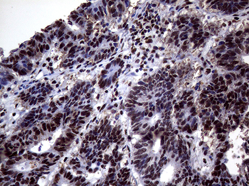 ANP32C Antibody - Immunohistochemical staining of paraffin-embedded Adenocarcinoma of Human colon tissue using anti-ANP32C mouse monoclonal antibody. (Heat-induced epitope retrieval by 1mM EDTA in 10mM Tris buffer. (pH8.5) at 120°C for 3 min. (1:2000)