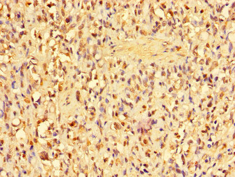 ANP32D Antibody - Immunohistochemistry of paraffin-embedded human gastric cancer tissue using ANP32D Antibody at dilution of 1:100