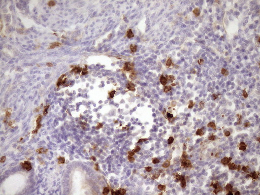 ANPEP / CD13 Antibody - Immunohistochemical staining of paraffin-embedded Carcinoma of Human pancreas tissue using anti-ANPEP mouse monoclonal antibody. (Heat-induced epitope retrieval by Tris-EDTA, pH8.0)(1:150)