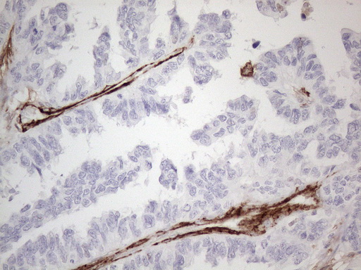 ANPEP / CD13 Antibody - Immunohistochemical staining of paraffin-embedded Adenocarcinoma of Human ovary tissue using anti-ANPEP mouse monoclonal antibody. (Heat-induced epitope retrieval by 1mM EDTA in 10mM Tris buffer. (pH8.5) at 120°C for 3 min. (1:150)