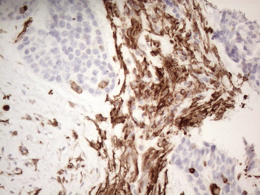 ANPEP / CD13 Antibody - Immunohistochemical staining of paraffin-embedded Adenocarcinoma of Human endometrium tissue using anti-ANPEP mouse monoclonal antibody. (Heat-induced epitope retrieval by 1mM EDTA in 10mM Tris buffer. (pH8.5) at 120°C for 3 min. (1:150)