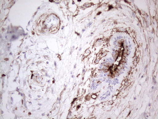 ANPEP / CD13 Antibody - Immunohistochemical staining of paraffin-embedded Adenocarcinoma of Human breast tissue using anti-ANPEP mouse monoclonal antibody. (Heat-induced epitope retrieval by 1mM EDTA in 10mM Tris buffer. (pH8.5) at 120°C for 3 min. (1:150)