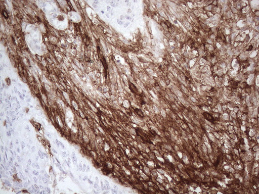 ANPEP / CD13 Antibody - Immunohistochemical staining of paraffin-embedded Adenocarcinoma of Human colon tissue using anti-ANPEP mouse monoclonal antibody. (Heat-induced epitope retrieval by 1mM EDTA in 10mM Tris buffer. (pH8.5) at 120°C for 3 min. (1:150)