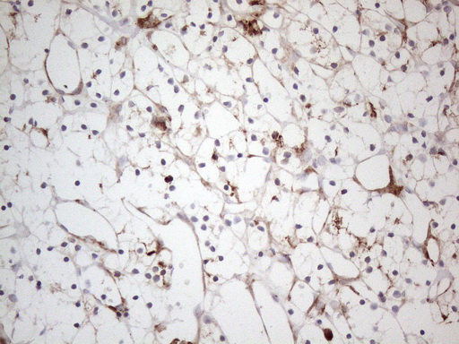 ANPEP / CD13 Antibody - Immunohistochemical staining of paraffin-embedded Carcinoma of Human kidney tissue using anti-ANPEP mouse monoclonal antibody. (Heat-induced epitope retrieval by 1mM EDTA in 10mM Tris buffer. (pH8.5) at 120°C for 3 min. (1:150)