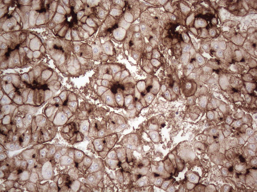 ANPEP / CD13 Antibody - Immunohistochemical staining of paraffin-embedded Carcinoma of Human liver tissue using anti-ANPEP mouse monoclonal antibody. (Heat-induced epitope retrieval by 1mM EDTA in 10mM Tris buffer. (pH8.5) at 120°C for 3 min. (1:150)