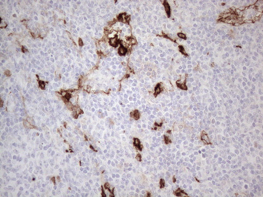 ANPEP / CD13 Antibody - Immunohistochemical staining of paraffin-embedded Human lymphoma tissue using anti-ANPEP mouse monoclonal antibody. (Heat-induced epitope retrieval by 1mM EDTA in 10mM Tris buffer. (pH8.5) at 120°C for 3 min. (1:150)