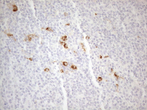 ANPEP / CD13 Antibody - Immunohistochemical staining of paraffin-embedded Human lymphoma tissue using anti-ANPEP mouse monoclonal antibody. (Heat-induced epitope retrieval by 1mM EDTA in 10mM Tris buffer. (pH8.5) at 120°C for 3 min. (1:150)