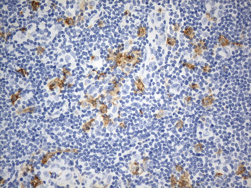 ANPEP / CD13 Antibody - Immunohistochemical staining of paraffin-embedded Human lymphoma tissue using anti-CD13 mouse monoclonal antibody. (Heat-induced epitope retrieval by 1mM EDTA in 10mM Tris buffer. (pH8.0) at 120°C for 2.5 min. (1:1000)