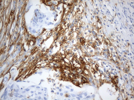 ANPEP / CD13 Antibody - Immunohistochemical staining of paraffin-embedded Adenocarcinoma of Human endometrium tissue using anti-CD13 mouse monoclonal antibody. (Heat-induced epitope retrieval by 1mM EDTA in 10mM Tris buffer. (pH8.0) at 120°C for 2.5 min. (1:1000)