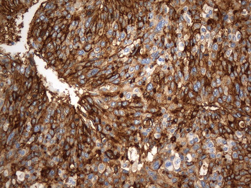 ANPEP / CD13 Antibody - Immunohistochemical staining of paraffin-embedded Carcinoma of Human liver tissue using anti-CD13 mouse monoclonal antibody. (Heat-induced epitope retrieval by 1mM EDTA in 10mM Tris buffer. (pH8.0) at 120°C for 2.5 min. (1:1000)