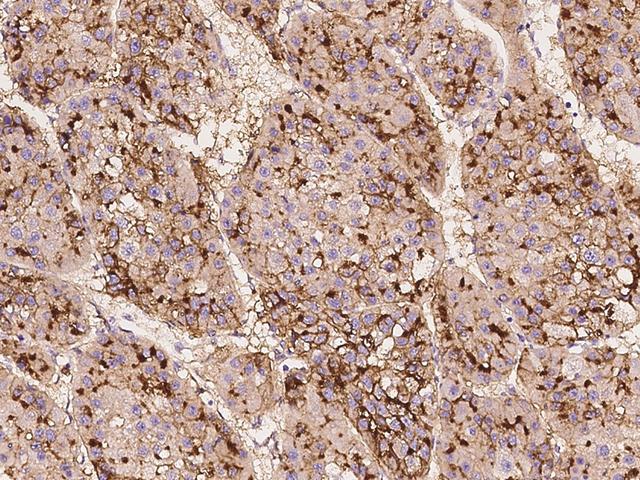 ANPEP / CD13 Antibody - Immunochemical staining of human ANPEP in human hepatoma with rabbit monoclonal antibody at 1:200 dilution, formalin-fixed paraffin embedded sections.