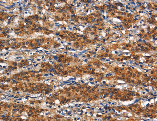 ANPEP / CD13 Antibody - Immunohistochemistry of paraffin-embedded Human thyroid cancer using ANPEP Polyclonal Antibody at dilution of 1:80.