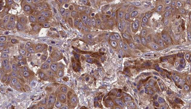 ANPEP / CD13 Antibody - 1:100 staining human liver carcinoma tissues by IHC-P. The sample was formaldehyde fixed and a heat mediated antigen retrieval step in citrate buffer was performed. The sample was then blocked and incubated with the antibody for 1.5 hours at 22°C. An HRP conjugated goat anti-rabbit antibody was used as the secondary.