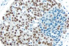 Breast Carcinoma: With Citrate-based Antigen Unmasking Solution, Estrogen receptor (rm), ImmPRESS™ Anti-Rabbit Ig Kit, DAB (brown) substrate. Hematoxylin QS (blue) counterstain.