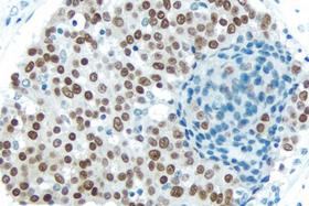 Product - Breast Carcinoma: With Citrate-based Antigen Unmasking Solution, Estrogen receptor (rm), ImmPRESS™ Anti-Rabbit Ig Kit, DAB (brown) substrate. Hematoxylin QS (blue) counterstain.