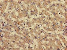 Antithrombin-III Antibody - Immunohistochemistry of paraffin-embedded human liver cancer at dilution of 1:100