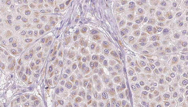 Antithrombin-III Antibody - 1:100 staining human Melanoma tissue by IHC-P. The sample was formaldehyde fixed and a heat mediated antigen retrieval step in citrate buffer was performed. The sample was then blocked and incubated with the antibody for 1.5 hours at 22°C. An HRP conjugated goat anti-rabbit antibody was used as the secondary.