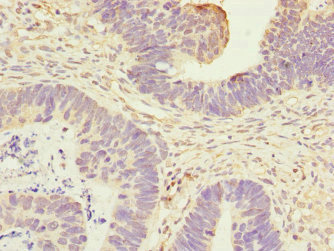 ANTXR2 / CMG2 Antibody - Immunohistochemistry of paraffin-embedded human ovarian cancer at dilution 1:100