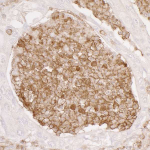 ANXA1 / Annexin A1 Antibody - Detection of human ANXA1 by immunohistochemistry. Sample: FFPE section of human lung carcinoma. Antibody: Affinity purified rabbit anti-ANXA1 used at a dilution of 1:5,000 (0.2µg/ml). Detection: DAB