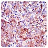 ANXA1 / Annexin A1 Antibody - Immunohistochemistry: Annexin A1 Antibody (2F1) - IHC analysis of paraffin embedded human cervical cancer tissues with DAB staining.  This image was taken for the unconjugated form of this product. Other forms have not been tested.