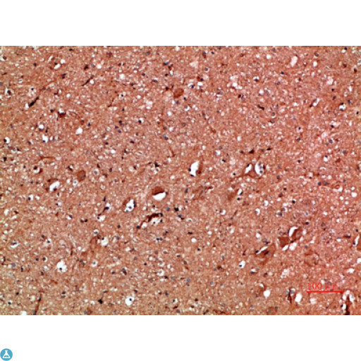 ANXA1 / Annexin A1 Antibody - Immunohistochemical analysis of human-breast-cancer tissue. Anti-Annexin I at 1:200 (4°C, overnight). Antigen retrieval - Sodium Citrate pH6 (>98°C, 20min). Secondary - 1:200 (room temp, 30min). Negative control - Secondary only
