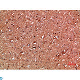 ANXA1 / Annexin A1 Antibody - Immunohistochemical analysis of human-breast-cancer tissue. Anti-Annexin I at 1:200 (4°C, overnight). Antigen retrieval - Sodium Citrate pH6 (>98°C, 20min). Secondary - 1:200 (room temp, 30min). Negative control - Secondary only