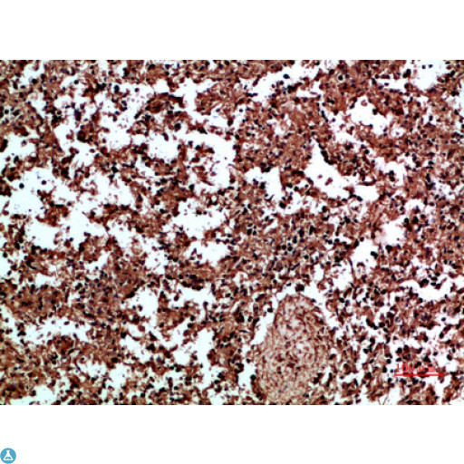 ANXA1 / Annexin A1 Antibody - Immunohistochemical analysis of human kidney cancer tissue. Anti-Annexin I at 1:200 (4°C, overnight). Antigen retrieval - Sodium Citrate pH6 (>98°C, 20min). Secondary - 1:200 (room temp, 30min). Negative control - Secondary only