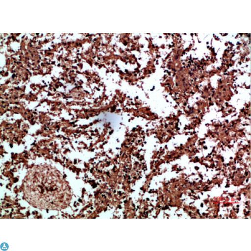 ANXA1 / Annexin A1 Antibody - Immunohistochemical analysis of human liver cancer tissue. Anti-Annexin I at 1:200 (4°C, overnight). Antigen retrieval - Sodium Citrate pH6 (>98°C, 20min). Secondary - 1:200 (room temp, 30min). Negative control - Secondary only