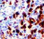 ANXA1 / Annexin A1 Antibody - IHC of Annexin A1 on FFPE Hairy Cell Leukemia tissue. This image was taken for the unmodified form of this product. Other forms have not been tested.