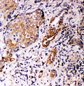 ANXA10 / Annexin A10 Antibody - ANXA10 / Annexin A10 antibody. IHC(P): Human Lung Cancer Tissue.