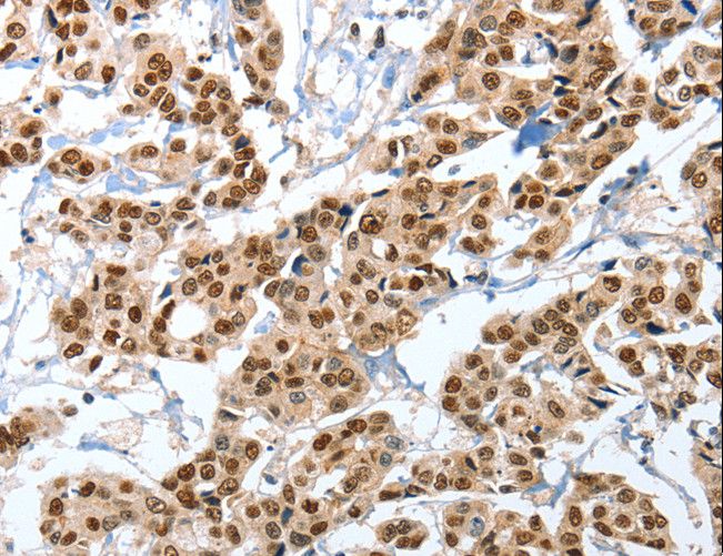ANXA10 / Annexin A10 Antibody - Immunohistochemistry of paraffin-embedded Human liver cancer using ANXA10 Polyclonal Antibody at dilution of 1:35.