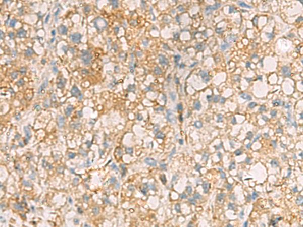 ANXA13 / Annexin XIII Antibody - Immunohistochemistry of paraffin-embedded Human liver cancer tissue  using ANXA13 Polyclonal Antibody at dilution of 1:105(×200)