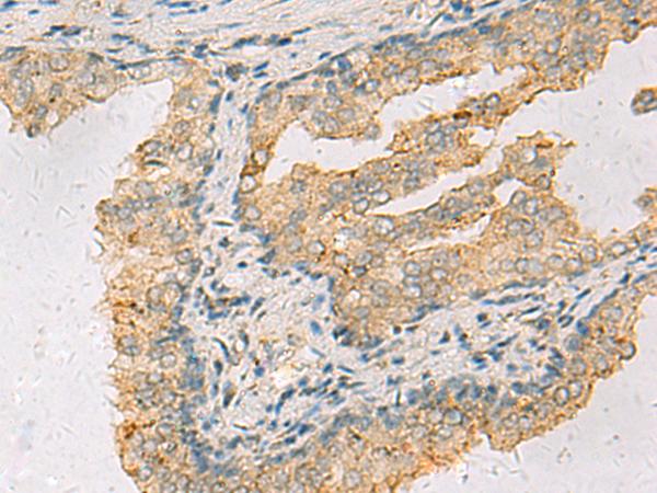 ANXA13 / Annexin XIII Antibody - Immunohistochemistry of paraffin-embedded Human prost ate cancer tissue  using ANXA13 Polyclonal Antibody at dilution of 1:105(×200)