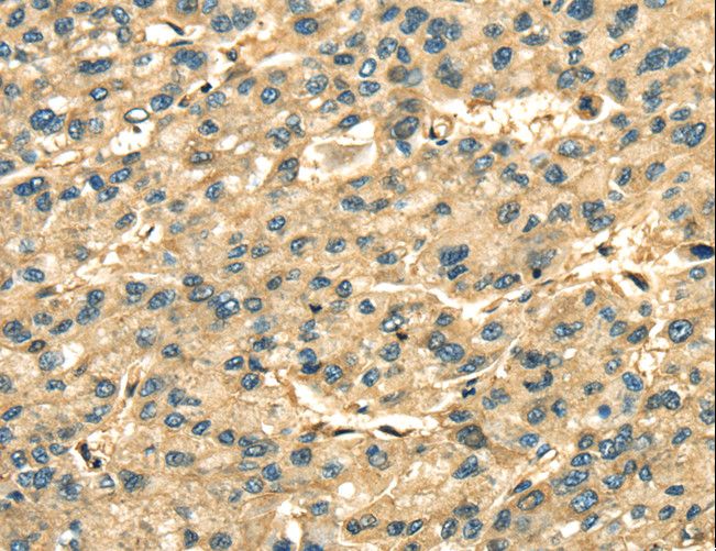 ANXA2 / Annexin A2 Antibody - Immunohistochemistry of paraffin-embedded Human liver cancer using ANXA2 Polyclonal Antibody at dilution of 1:35.