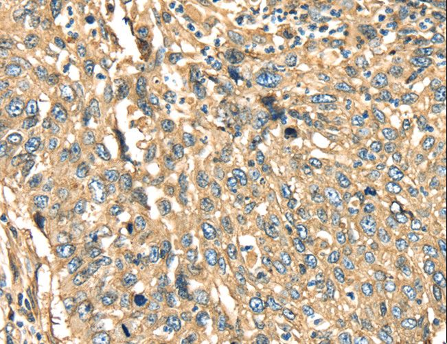 ANXA2 / Annexin A2 Antibody - Immunohistochemistry of paraffin-embedded Human lung cancer using ANXA2 Polyclonal Antibody at dilution of 1:40.
