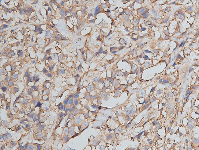 ANXA2 / Annexin A2 Antibody - 1:50 staining human breast carcinoma tissue by IHC-P. The tissue was formaldehyde fixed and a heat mediated antigen retrieval step in citrate buffer was performed. The tissue was then blocked and incubated with the antibody for 1.5 hours at 22°C. An HRP conjugated goat anti-rabbit antibody was used as the secondary.